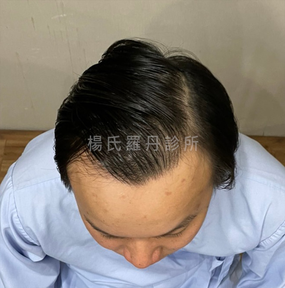 植髮術前前額高額頭伴隨掉髮紀錄照