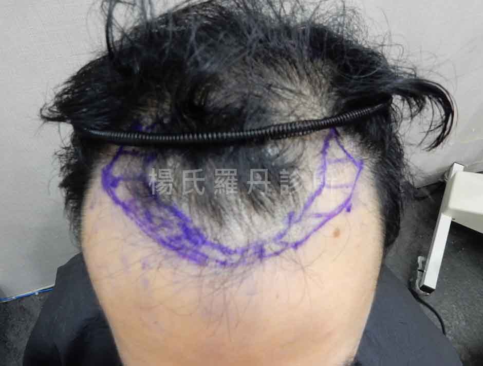 術前雄性禿髮線後退紀錄照
