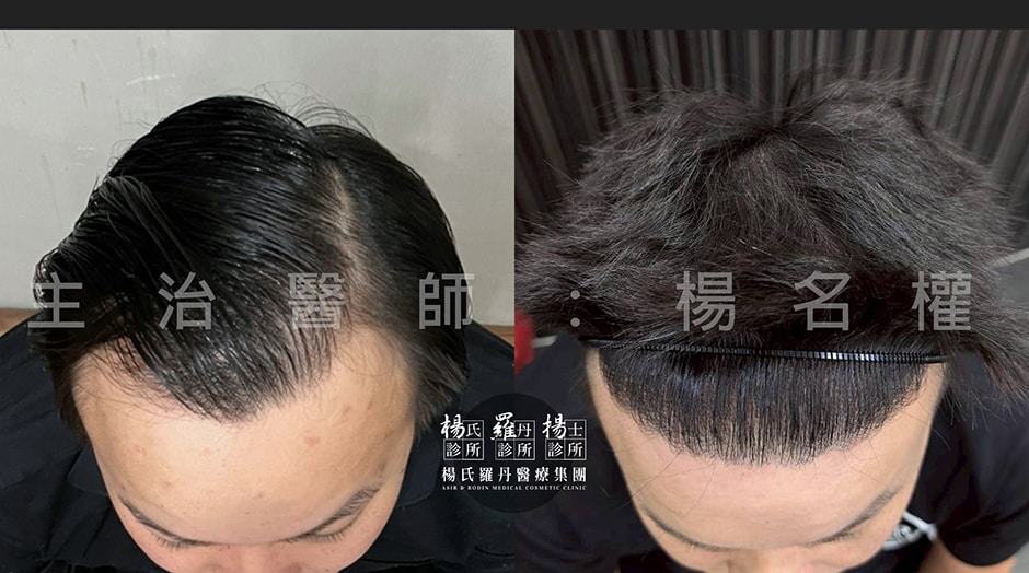 植髮術前與術後兩年對比紀錄照