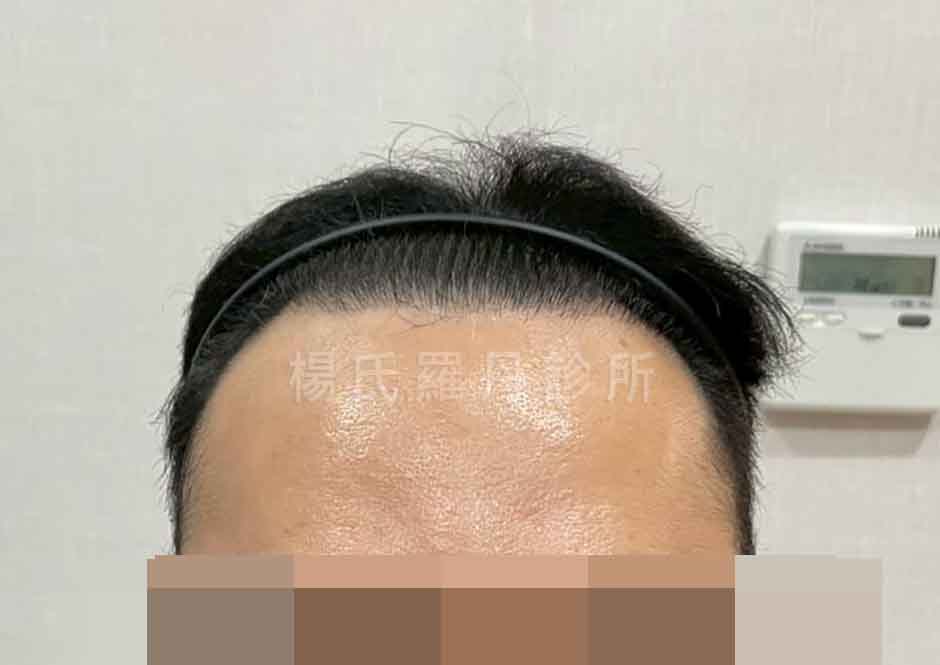 術後FUE植髮前額髮量填補照