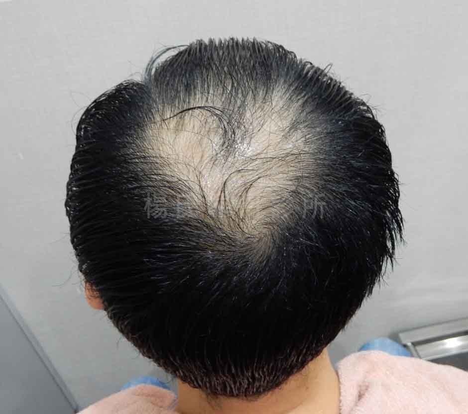 術前稀疏落髮特寫照