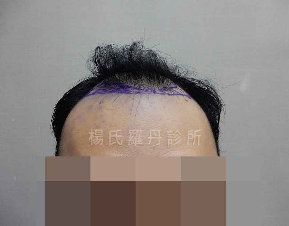 術前禿頭前額髮線退縮