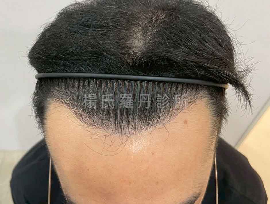 術後微創植髮髮際線重塑紀錄照