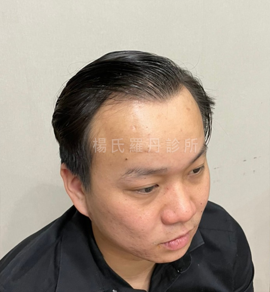 植髮術前頭頂毛髮細軟稀疏特寫照