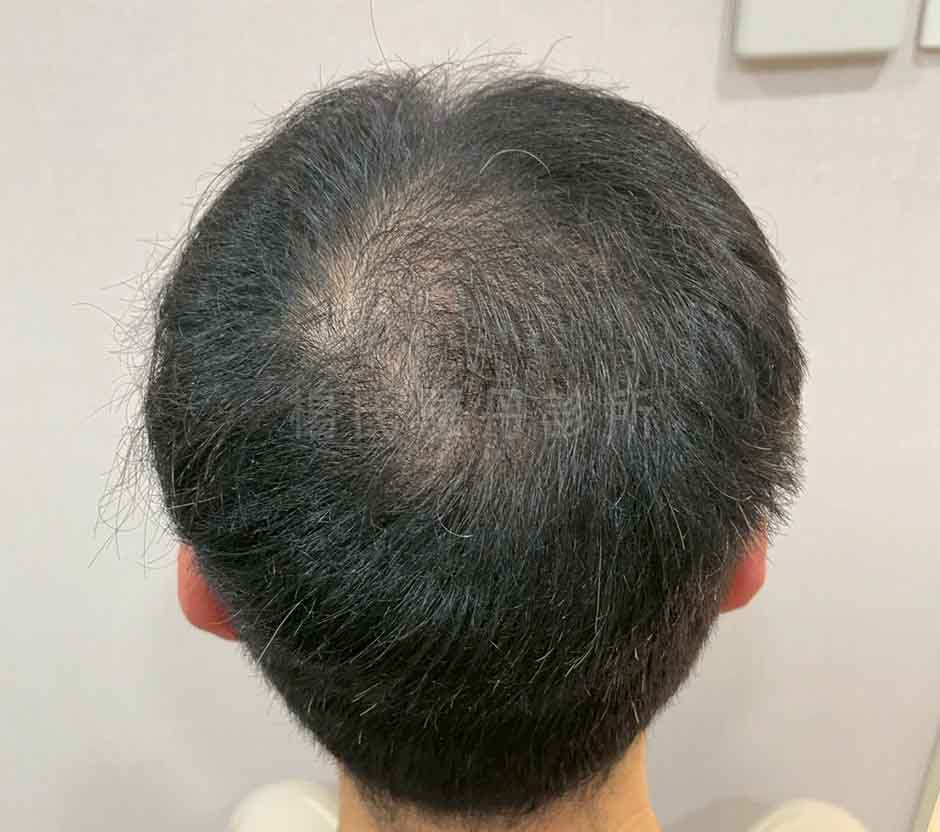 術後高密度植髮推薦特寫
