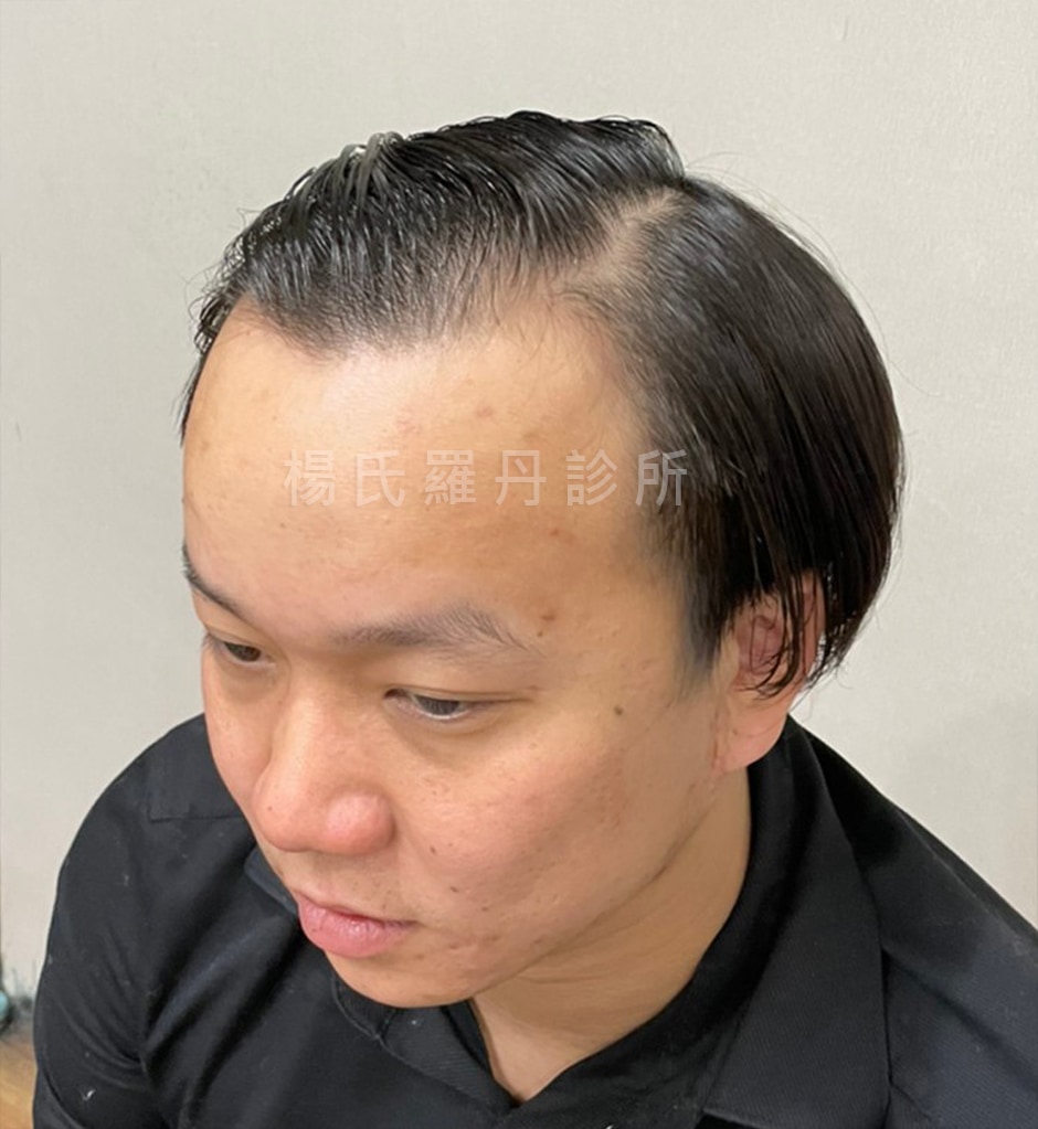 術前禿頭髮線退縮紀錄照