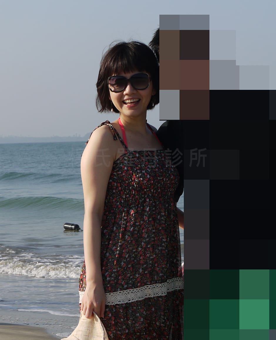 雷射減脂術前手臂蝴蝶袖明顯