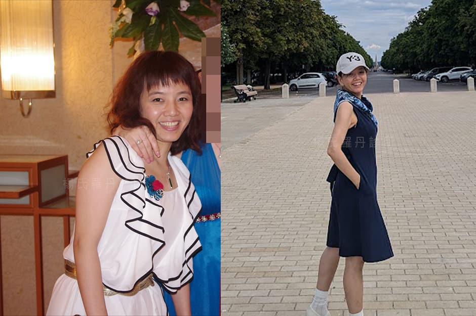 手臂雷射減脂術後局部雕塑對比