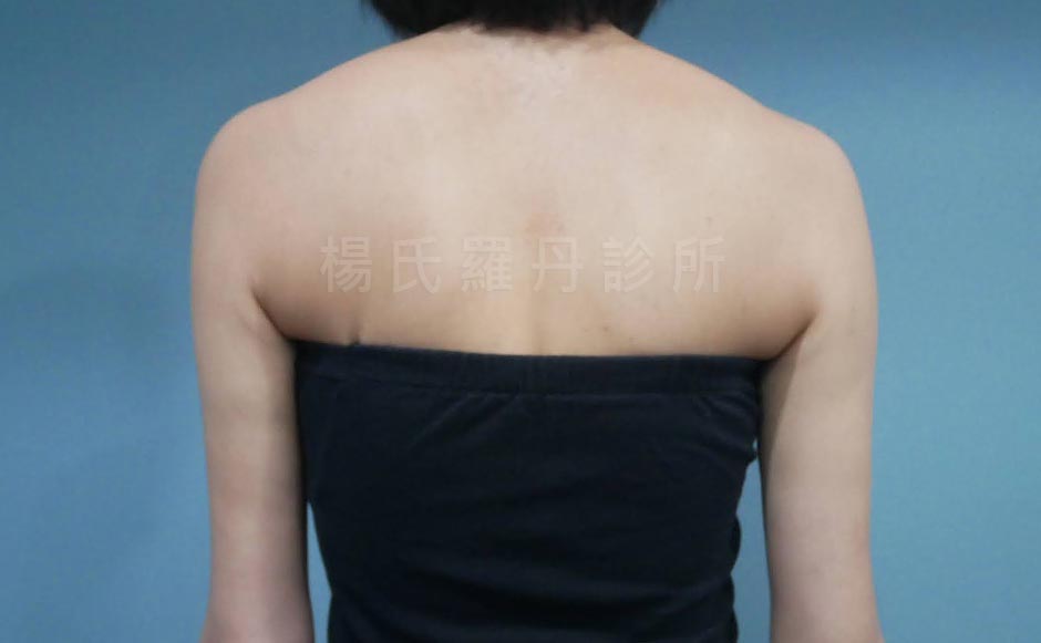 手臂雷射減脂術後4個月後背照