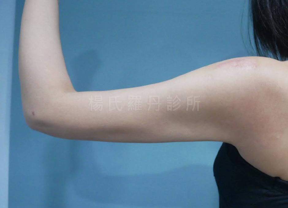 雷射減脂手臂雕塑術後瘦手臂