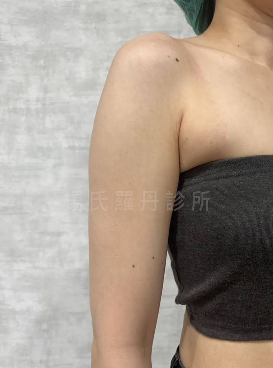 手臂抽脂術前的手臂肉