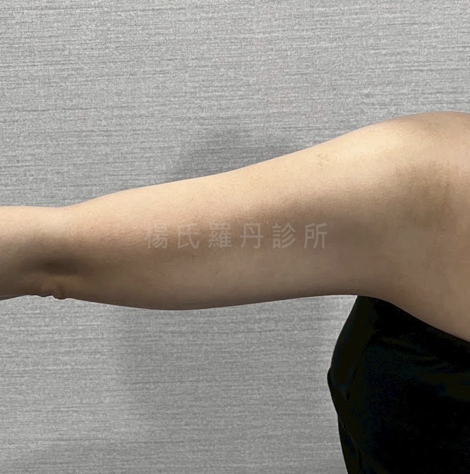 手臂雷射減脂術後4個月成果
