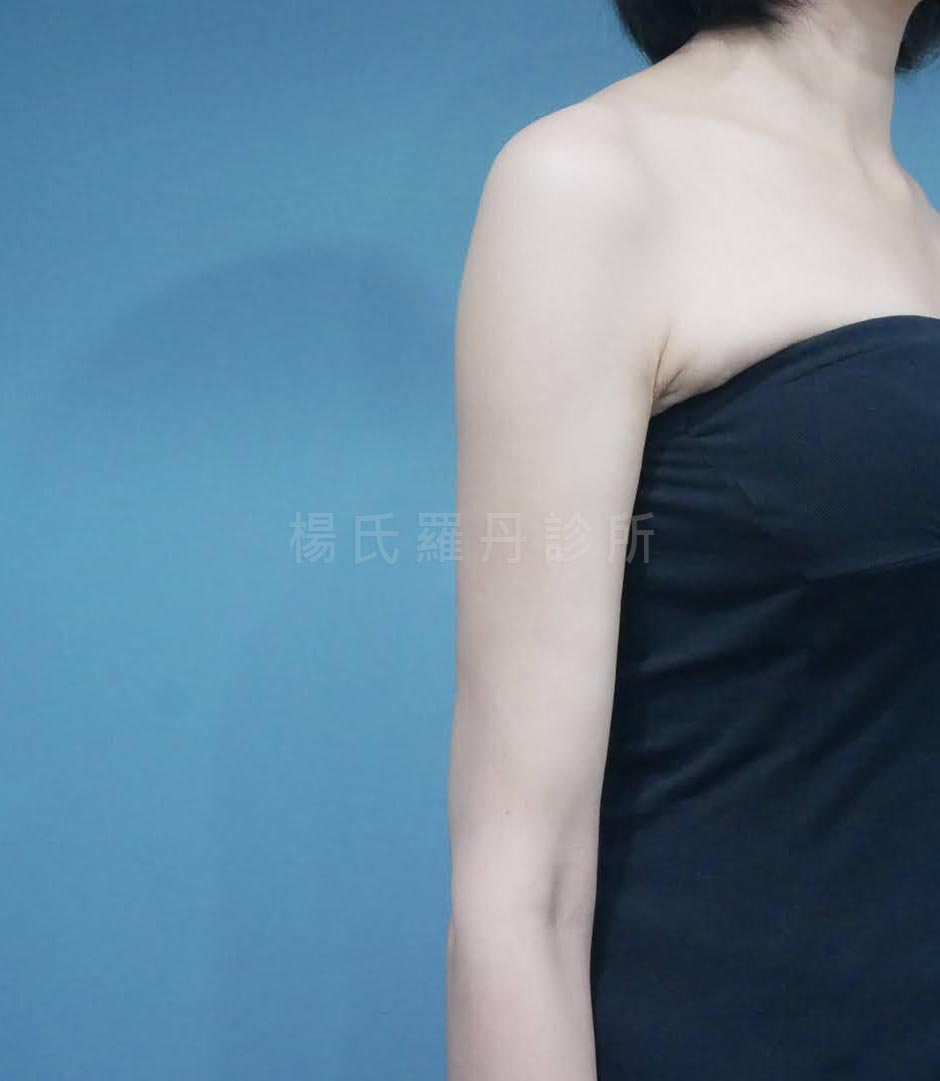 雷射減脂術後四個月成果照