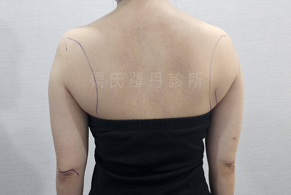 雷射減脂手術術前後背照