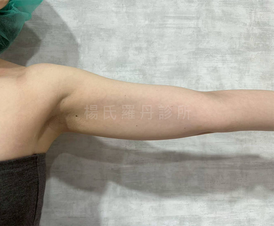 雷射減脂手術術前手臂照