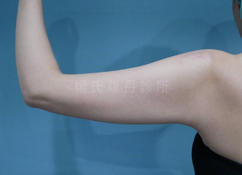 雷射減脂手術手臂術前狀態