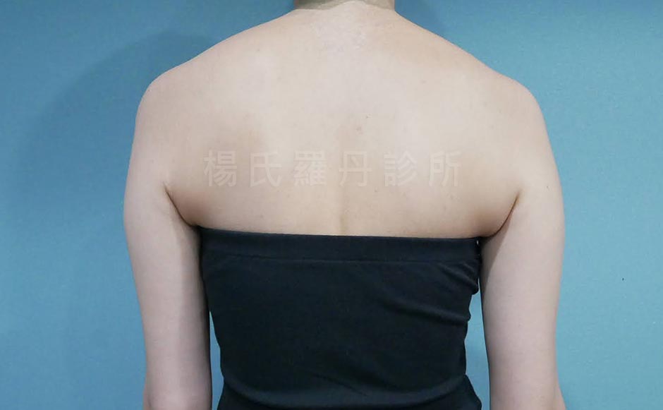 手臂雷射減脂術前後背照