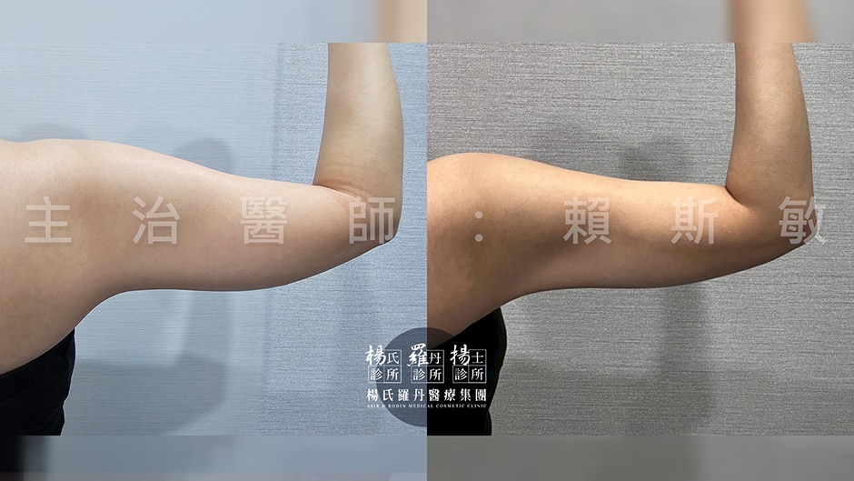 手臂雷射減脂術前術後對比照