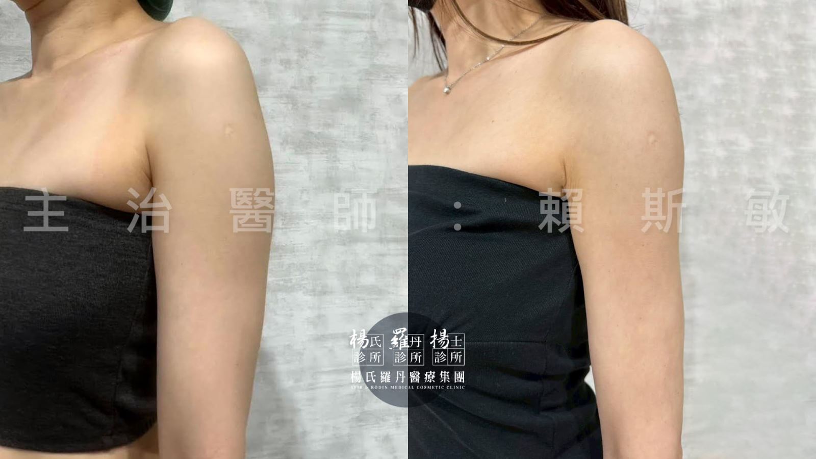 手臂雷射減脂術前術後對比照