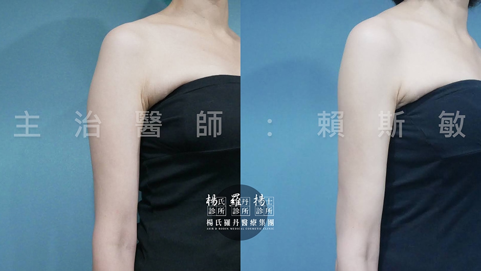 手臂雷射減脂術前術後對比照