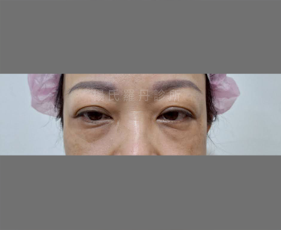 女性眼袋內開術前