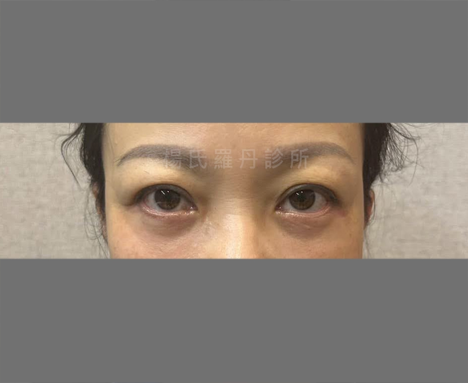 女性眼袋消除術後