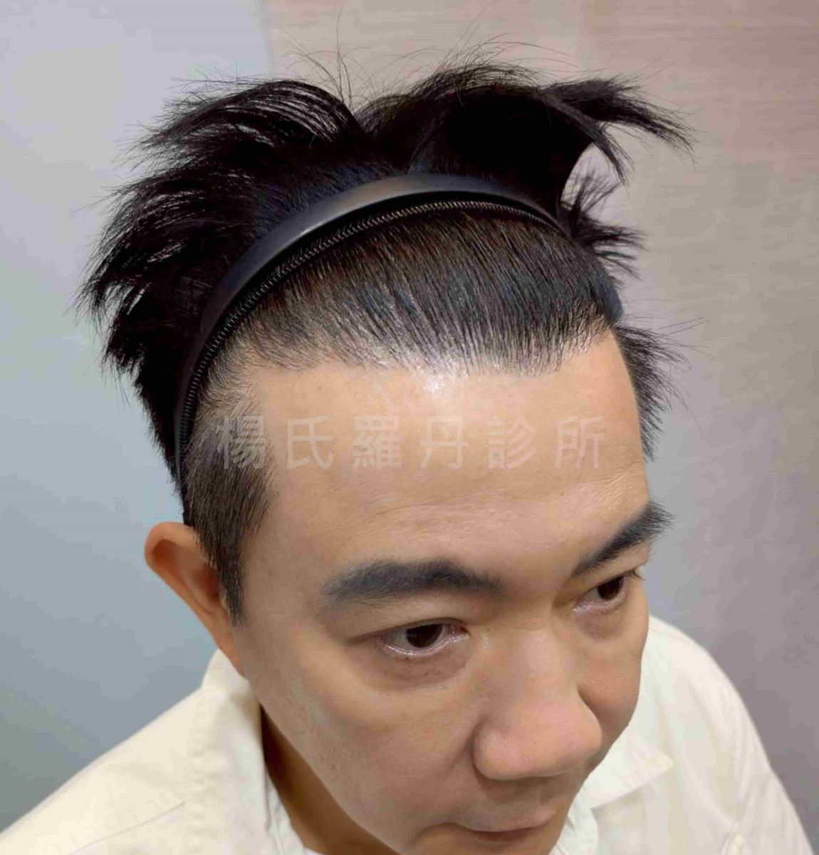 型男大主廚吳秉承M型禿植髮推薦術後增添髮量