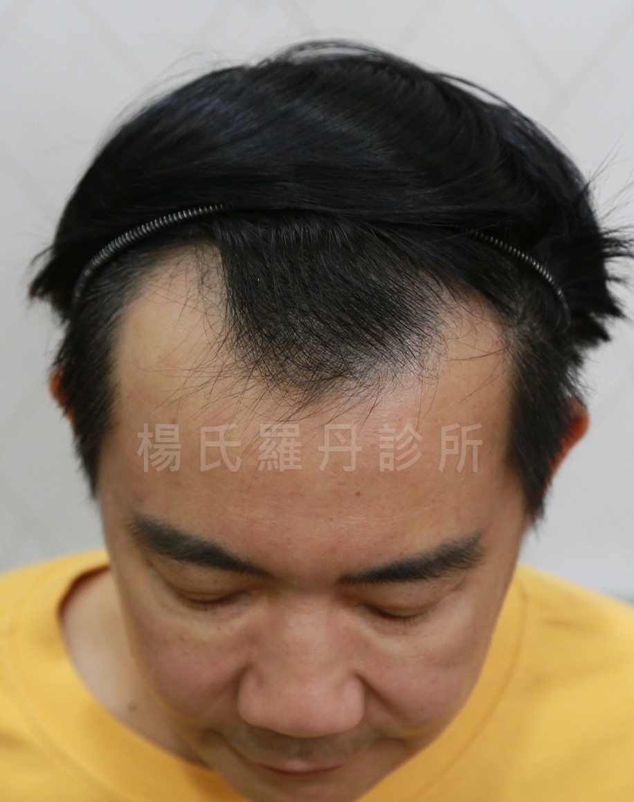 大主廚型男吳秉承M型禿植髮前髮際線