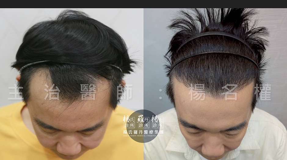 大主廚型男吳秉承植髮術後髮際線自然有型