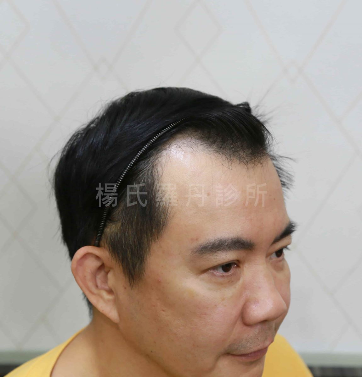 型男主廚吳秉承因掉髮決定植髮前