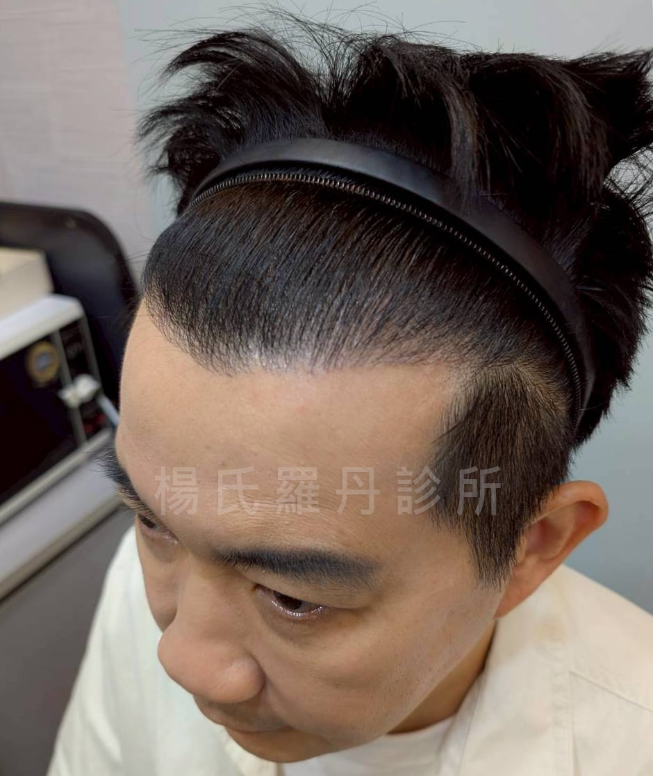大主廚型男吳秉承吳師傅植髮推薦台北術後