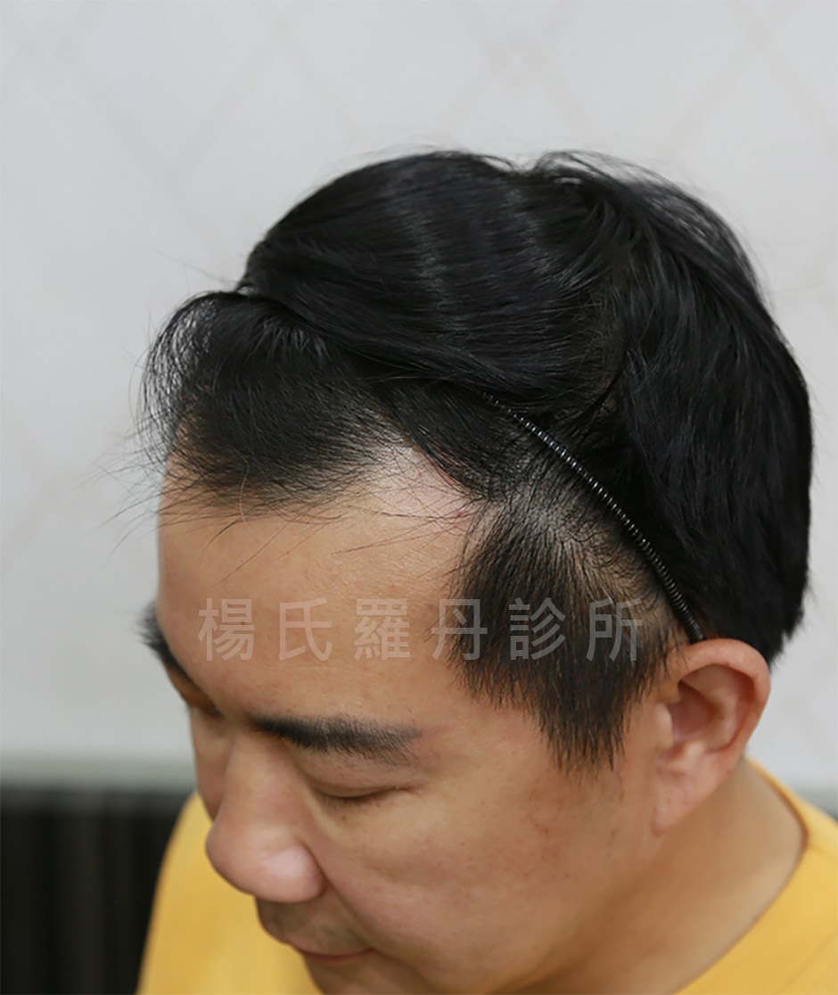型男大主廚吳秉承植髮術前髮際線後退明顯