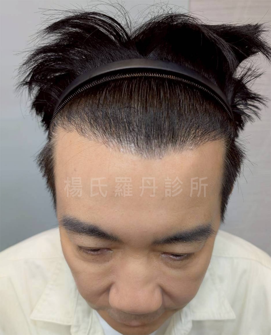 大主廚型男吳秉承微創植髮術後成果