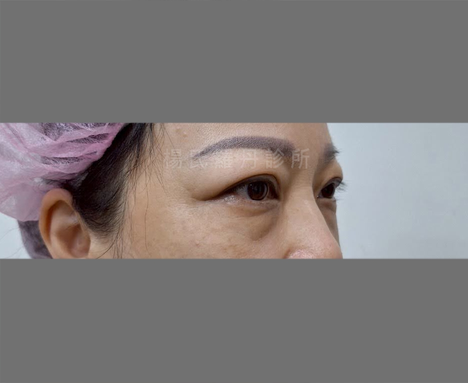 除眼袋術前有厚重眼袋