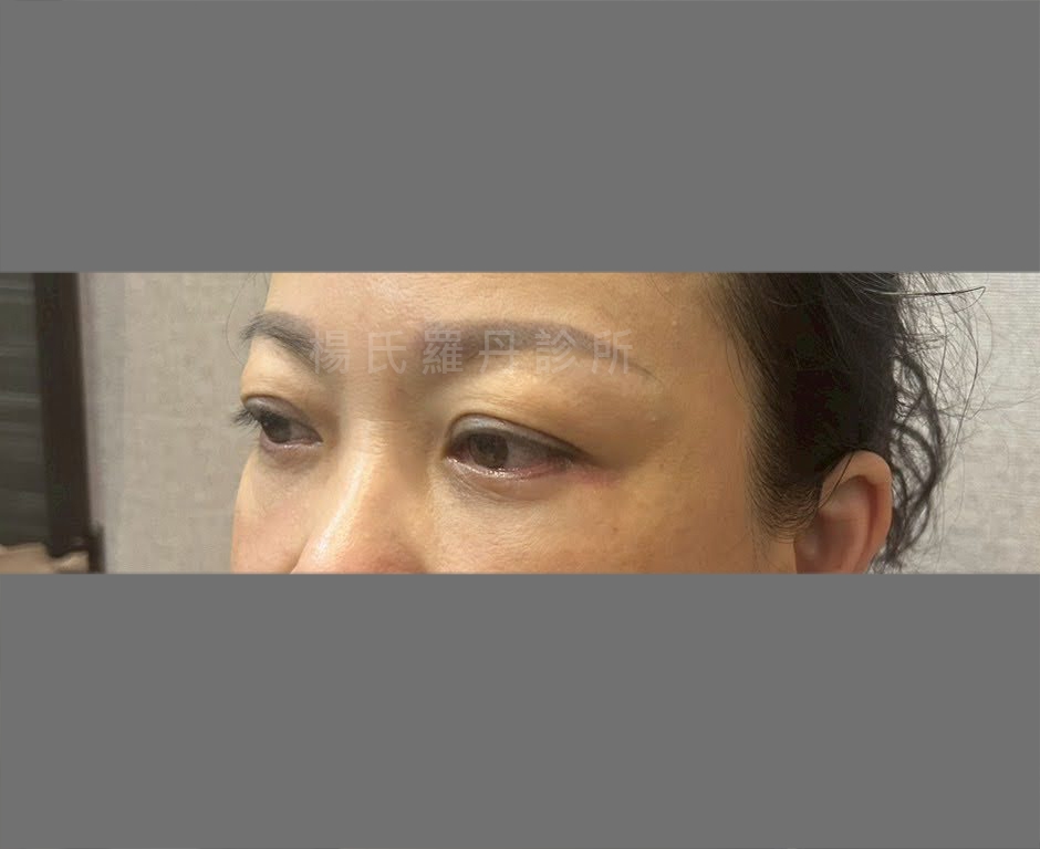 術後眼下平順無痕 術後將眼袋與淚溝消除