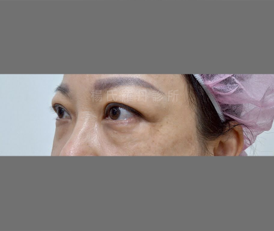 眼袋手術術前眼袋明顯