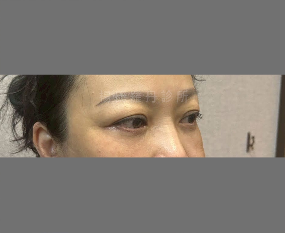術後視覺減齡有感 眼袋手術恢復期術後眼袋消失