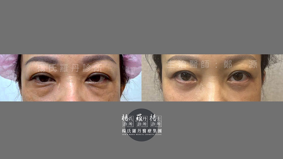眼袋術後三個月,無痕緊緻雙眼 眼袋手術推薦高雄術後三個月追蹤