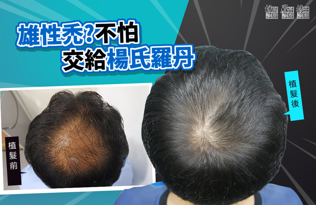 【植髮】雄性禿？不怕交給楊氏羅丹，ARTAS植髮改善落髮