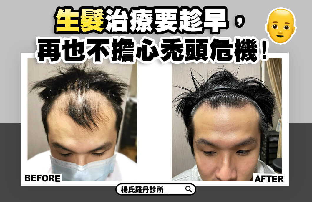 【複合式生髮】生髮治療要趁早，再也不擔心禿頭危機!