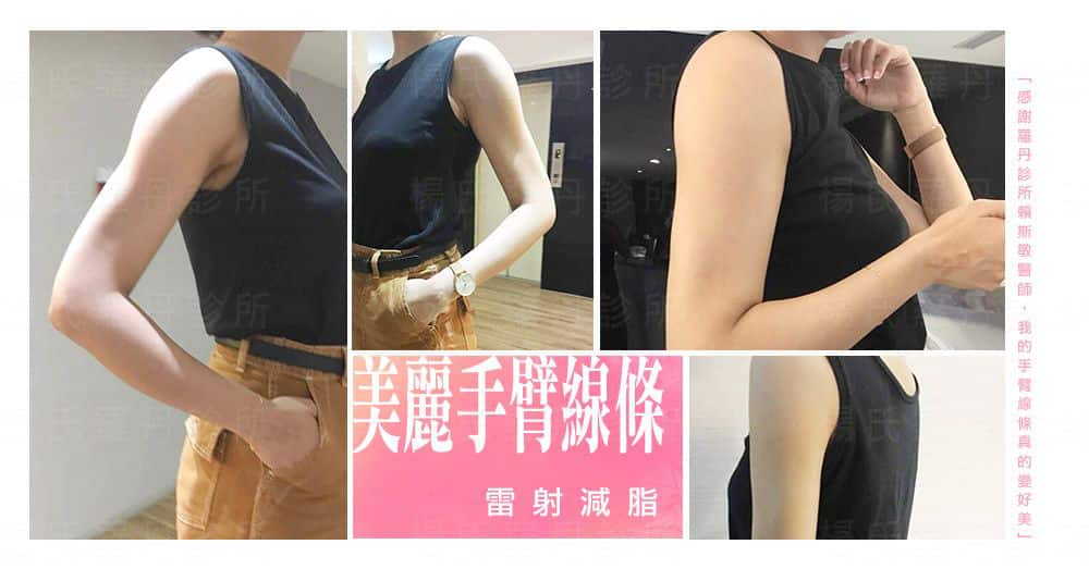 【台北˙雷射減脂瘦手臂】雷射減脂給妳美麗手臂線條！