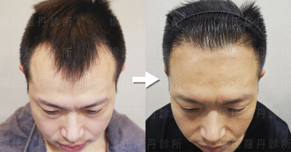 【台北˙植发】到罗丹诊所植发,不想再忍受m型秃了!