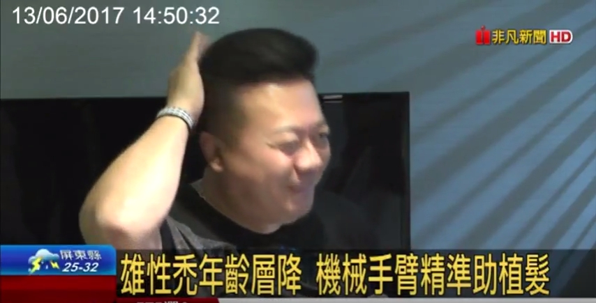 禿頭偏方生髮易傷害毛囊，董至成接受機器人植髮手術，髮量明顯增加