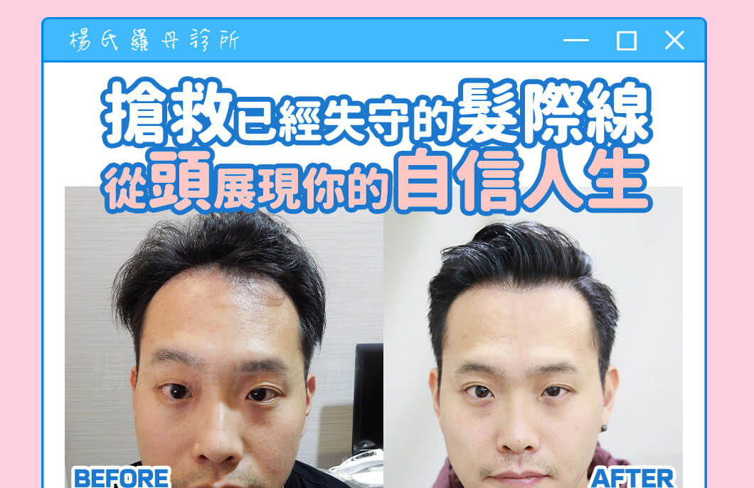 【植髮】搶救已經失守的髮際線，從頭展現你的自信人生