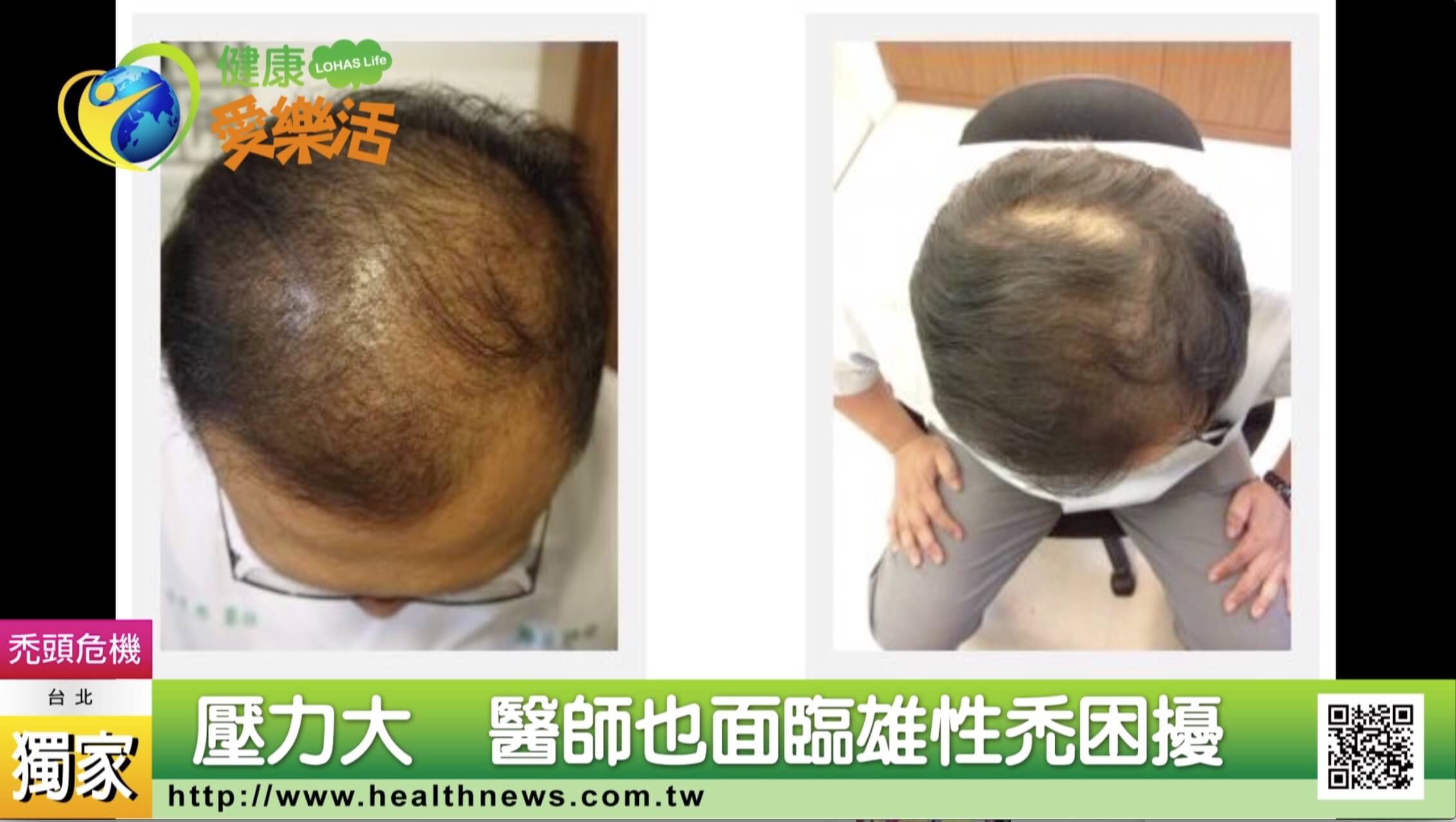親體驗機器人植髮 雄性禿醫師現身分享