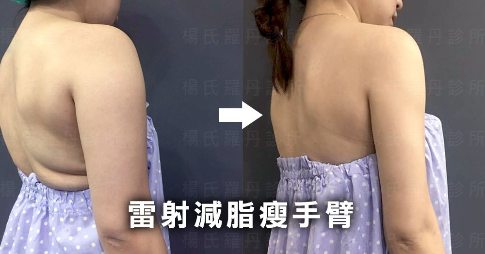 【雷射減脂】雷射減脂瘦手臂－我的副乳和厚背都消失了！