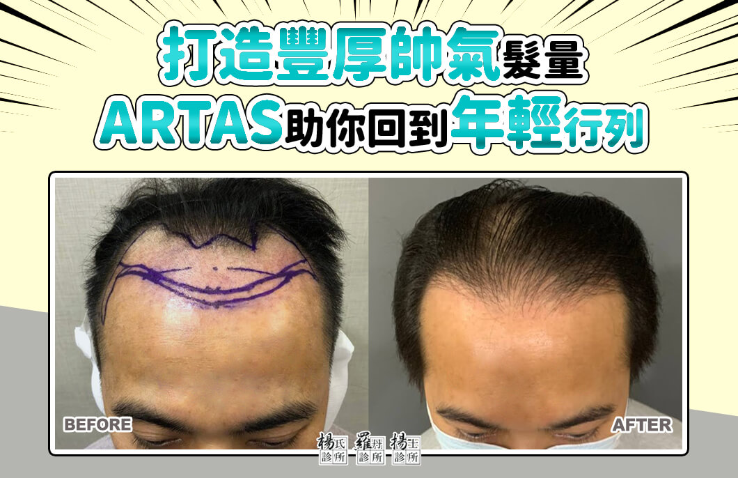 【植髮】打造豐厚帥氣髮量，ARTAS助你回到年輕行列