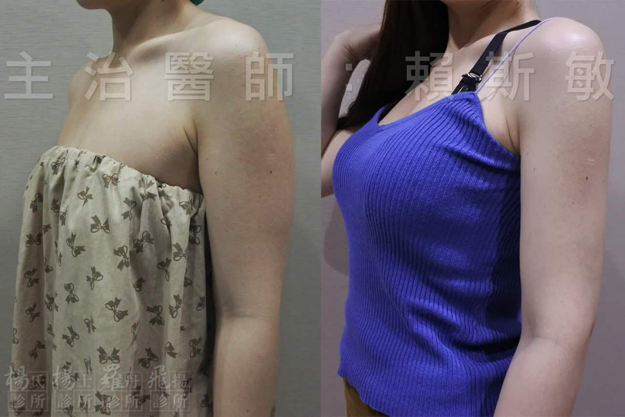 【雷射減脂】試穿禮服沒煩惱，雷射減脂讓我手臂瘦下來!