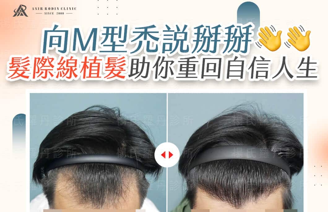 【植髮】向M型禿說掰掰，髮際線植髮助你重回自信人生