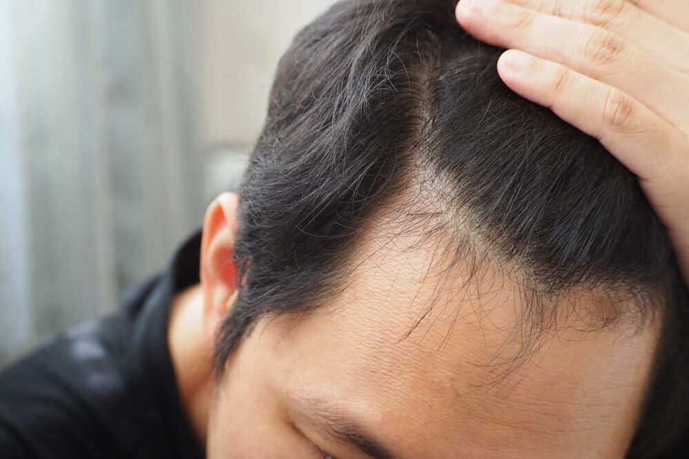 M型禿原因是什麼？3個治療方法，幫助你找回烏黑秀髮